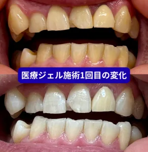 施術1回目の変化